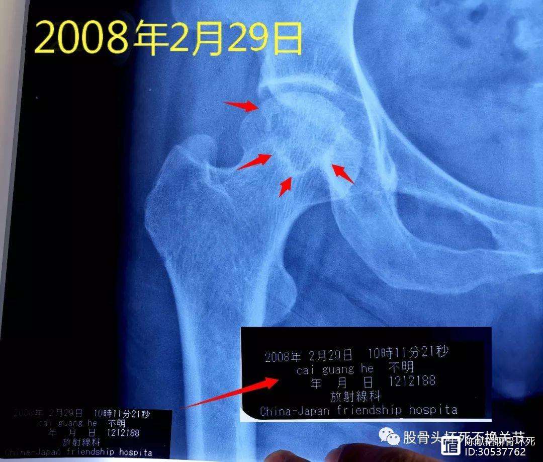 铁岭人工骨头医保报销多少(人工骨头医保报销多少比例)